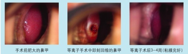 仁品低温等离子对比图
