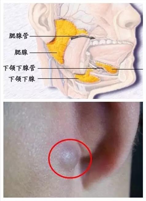 比如使用药膏,长时间贴耳打手机这些因素都对人体的腮腺部位有所刺激